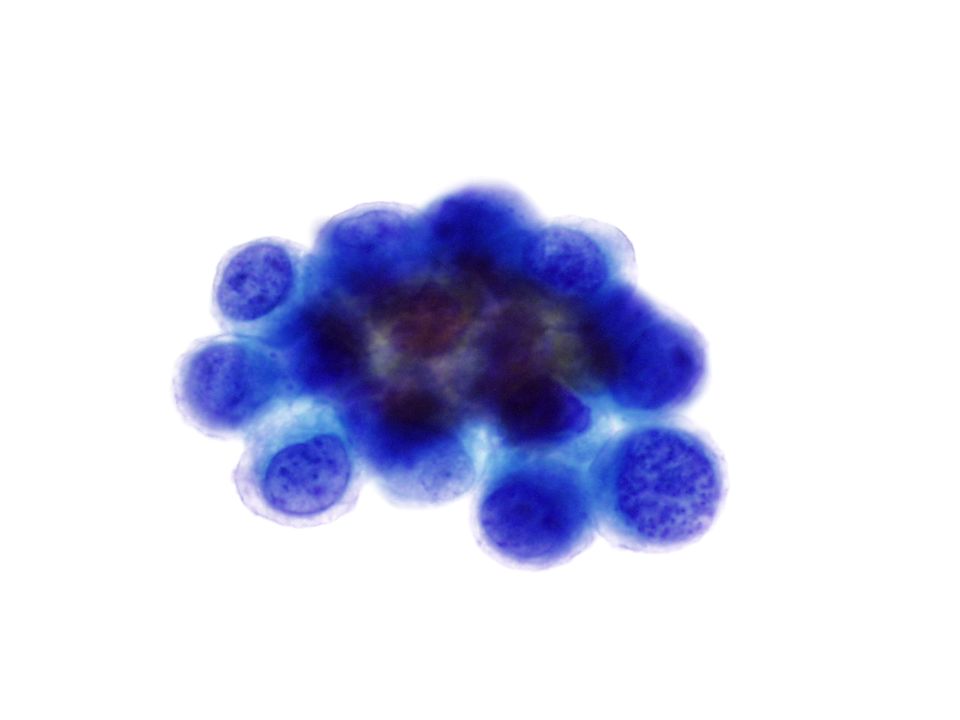 CIS normalmente tienen un células como las de un carcinoma de alto grado con frecuentes mitosis y un fondo notablemente limpio.