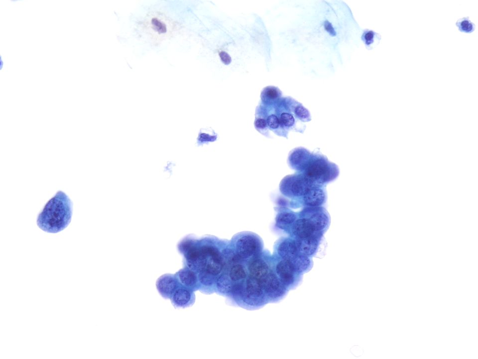 Imagen a 40X de un Carcinoma de Célula Transicional de Grado I-II confirmado por biopsia.
