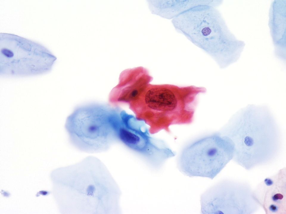 40X Imagen de células escamosas atípicas en una orina espontánea de una paciente femenina.