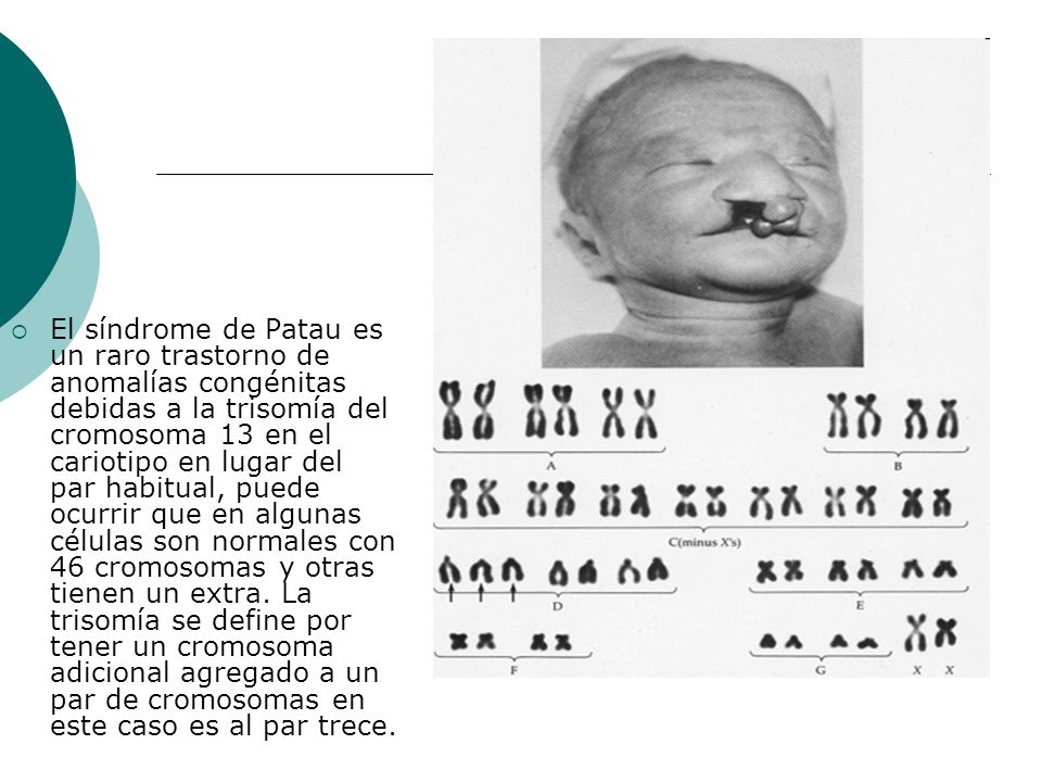 El síndrome de Patau es un raro trastorno de anomalías congénitas debidas a la trisomía del cromosoma 13 en el cariotipo en lugar del par habitual, puede ocurrir que en algunas células son normales con 46 cromosomas y otras tienen un extra.