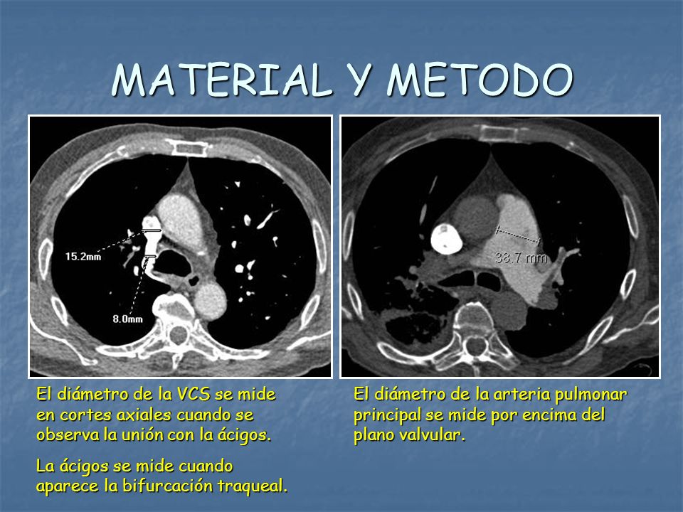 MATERIAL Y METODO El diámetro de la VCS se mide en cortes axiales cuando se observa la unión con la ácigos.