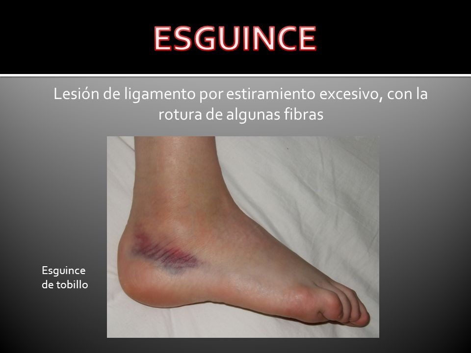 ESGUINCE Lesión de ligamento por estiramiento excesivo, con la rotura de algunas fibras. Esguince.