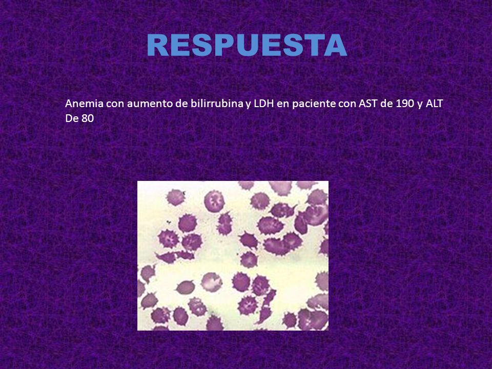 RESPUESTA Anemia con aumento de bilirrubina y LDH en paciente con AST de 190 y ALT De 80