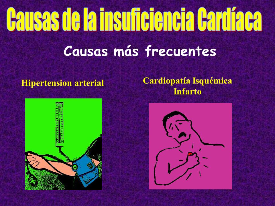Cardiopatía Isquémica