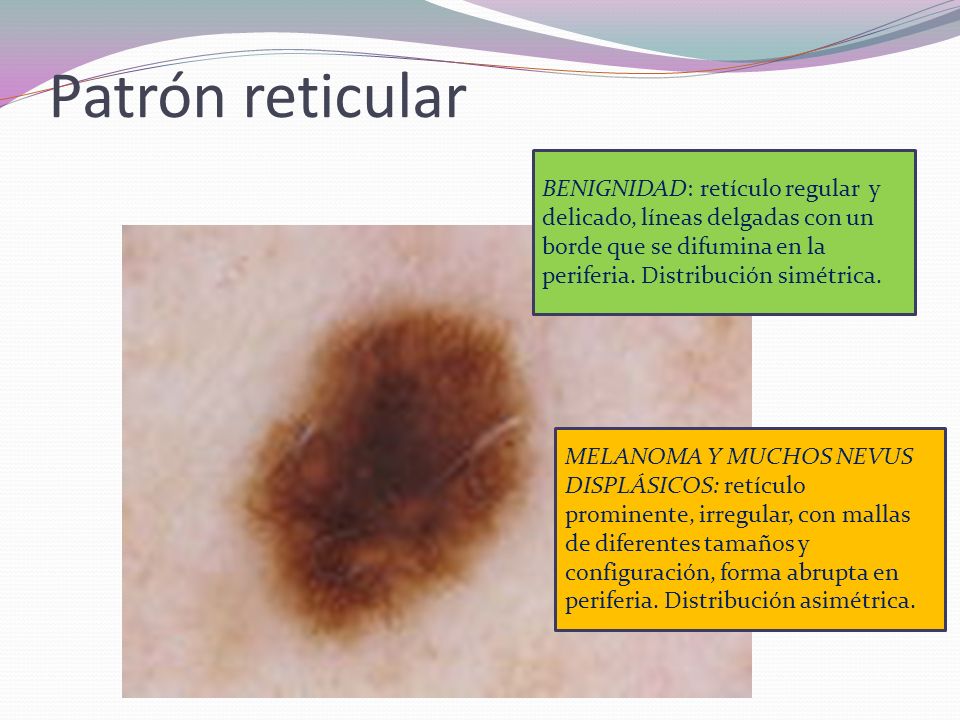 Patrón reticular BENIGNIDAD: retículo regular y delicado, líneas delgadas con un borde que se difumina en la periferia. Distribución simétrica.