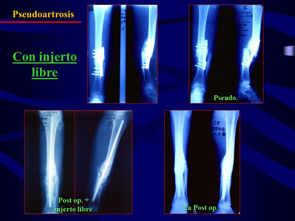 Con injerto libre Pseudoartrosis Pseudo. Post op. + injerto libre