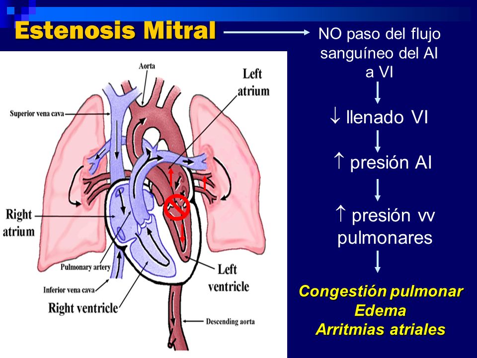 Estenosis Mitral  llenado VI  presión AI  presión vv pulmonares