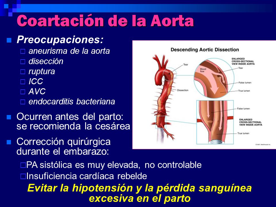 Evitar la hipotensión y la pérdida sanguínea excesiva en el parto
