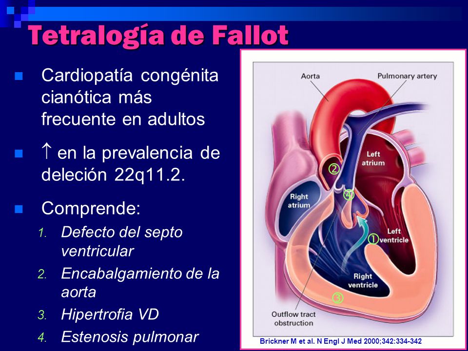 Tetralogía de Fallot Cardiopatía congénita cianótica más frecuente en adultos.  en la prevalencia de deleción 22q11.2.