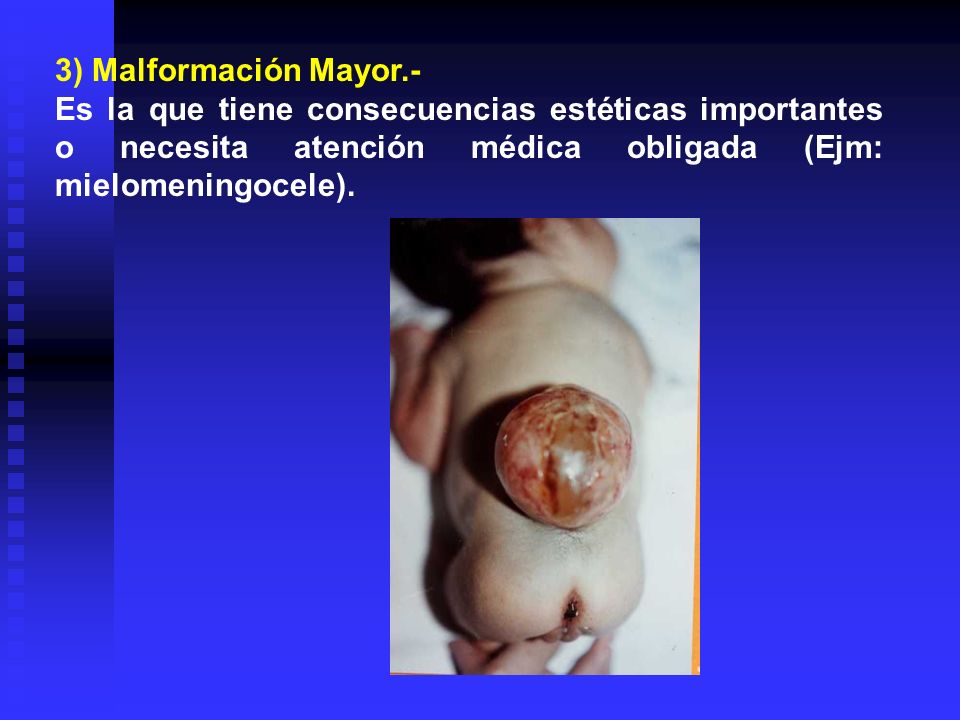 3) Malformación Mayor.- Es la que tiene consecuencias estéticas importantes o necesita atención médica obligada (Ejm: mielomeningocele).