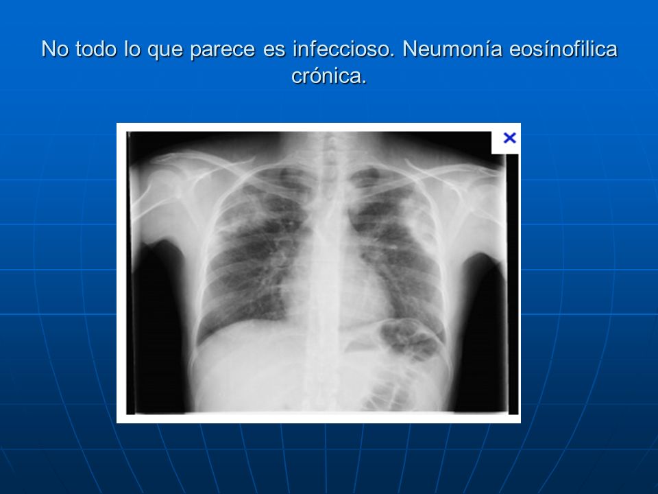 No todo lo que parece es infeccioso. Neumonía eosínofilica crónica.