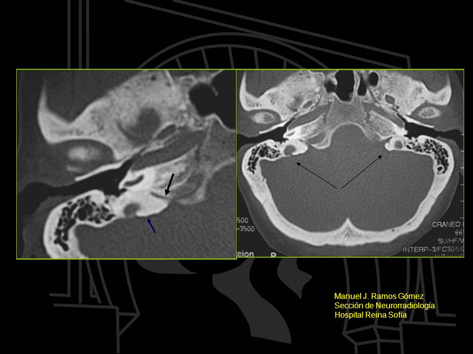 Manuel J. Ramos Gómez Sección de Neurorradiología Hospital Reina Sofía
