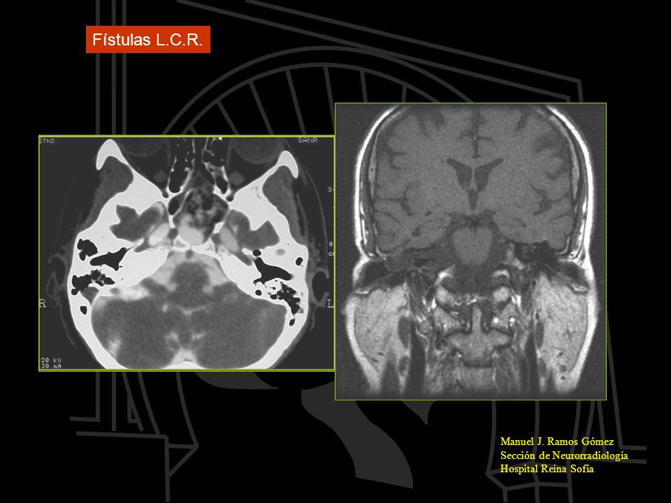 Fístulas L.C.R. Manuel J. Ramos Gómez Sección de Neurorradiología