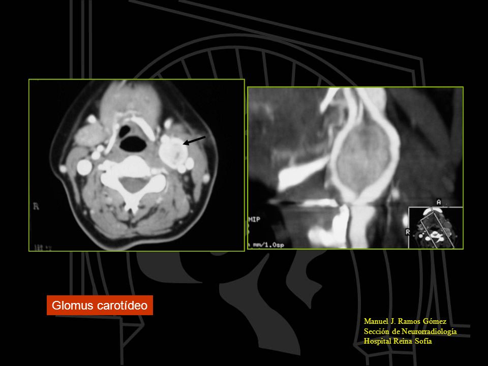 Glomus carotídeo Manuel J. Ramos Gómez Sección de Neurorradiología