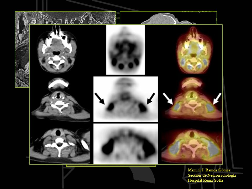 Manuel J. Ramos Gómez Sección de Neurorradiología Hospital Reina Sofía