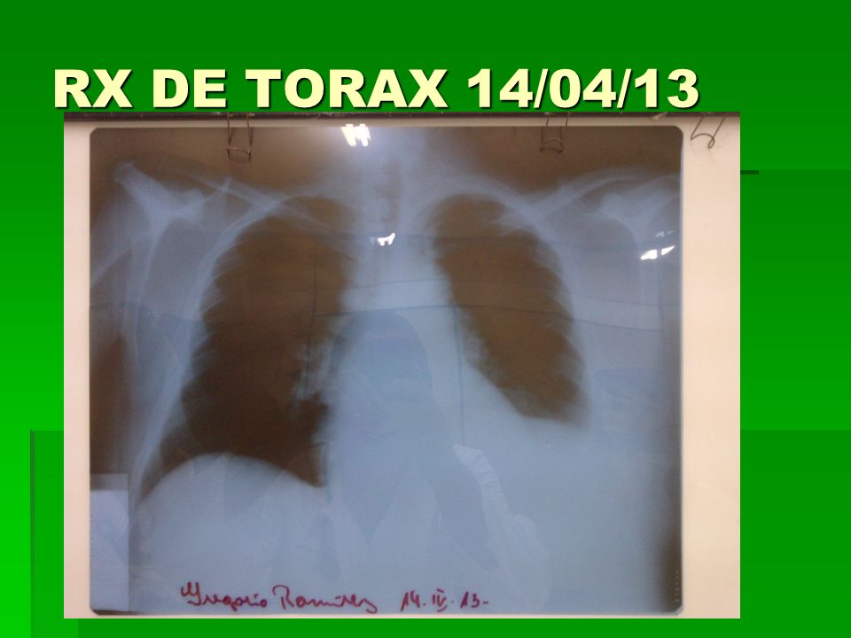 RX DE TORAX 14/04/13