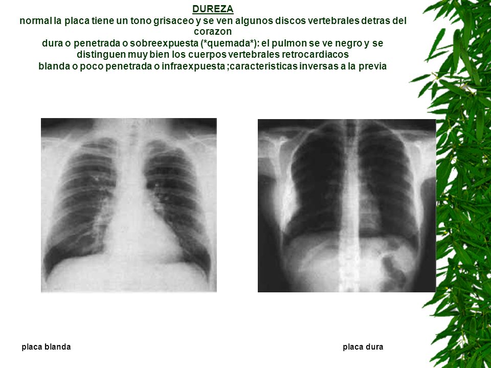 DUREZA normal la placa tiene un tono grisaceo y se ven algunos discos vertebrales detras del corazon dura o penetrada o sobreexpuesta (*quemada*): el pulmon se ve negro y se distinguen muy bien los cuerpos vertebrales retrocardiacos blanda o poco penetrada o infraexpuesta ;caracteristicas inversas a la previa