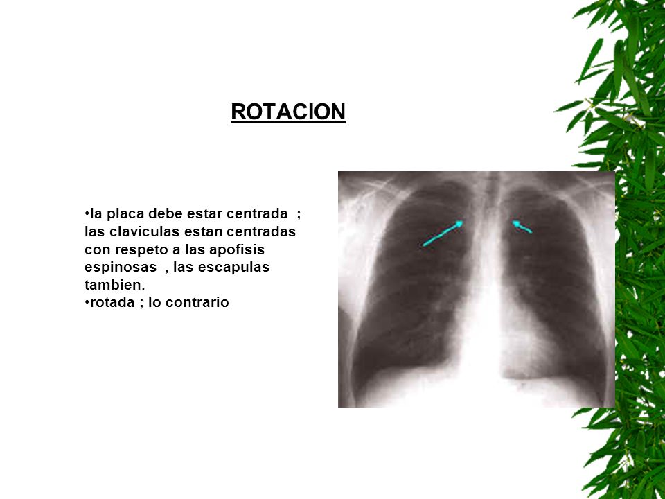 ROTACION la placa debe estar centrada ; las claviculas estan centradas con respeto a las apofisis espinosas , las escapulas tambien.