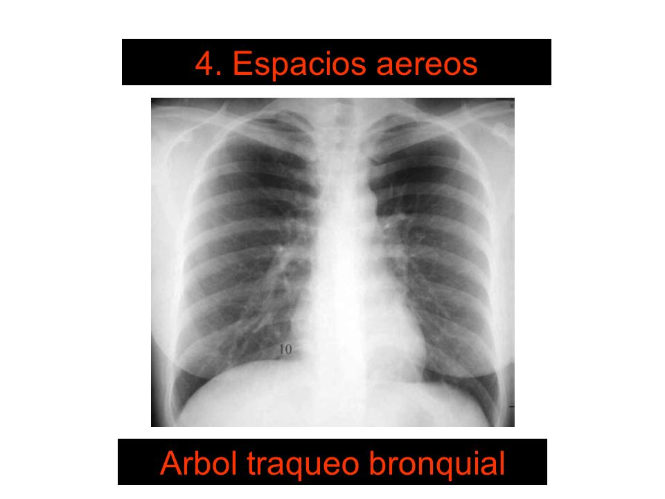 Arbol traqueo bronquial