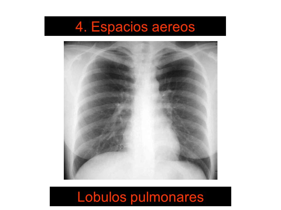 SISTEMA DE LECTURA 4. Espacios aereos Lobulos pulmonares