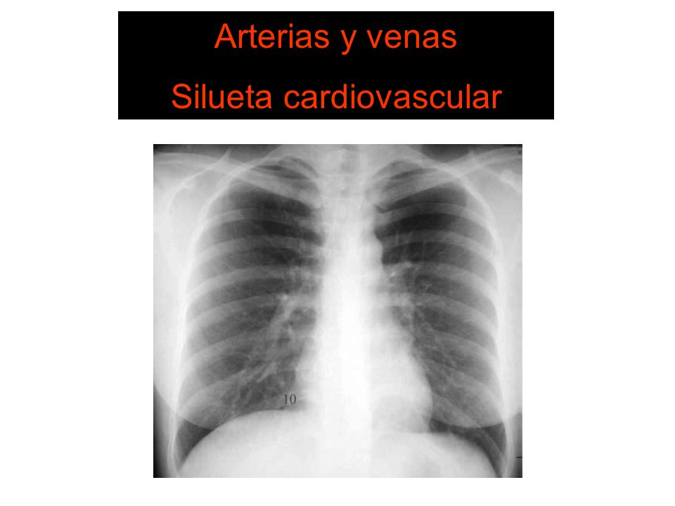 Silueta cardiovascular 6. Estructuras vasculares