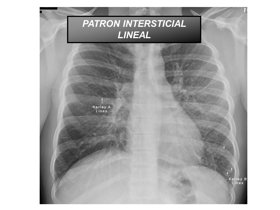 PATRON INTERSTICIAL LINEAL