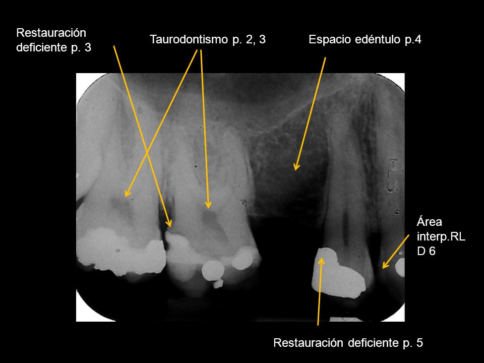 Restauración deficiente p. 3. Taurodontismo p. 2, 3. Espacio edéntulo p.4. Área. interp.RL. D 6.