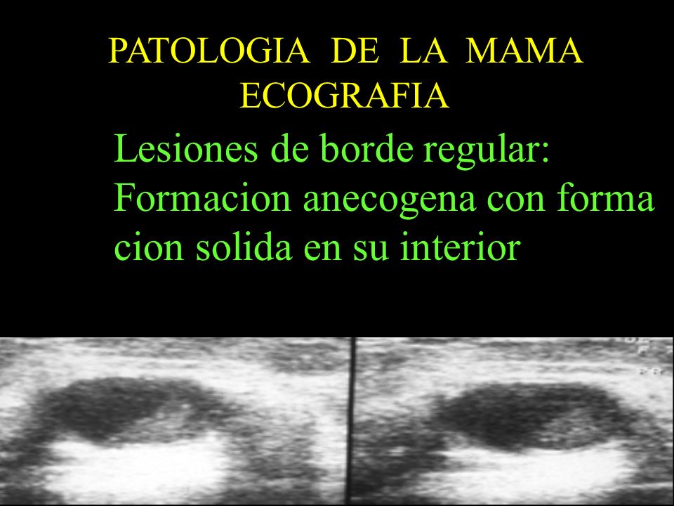 Lesiones de borde regular: Formacion anecogena con forma
