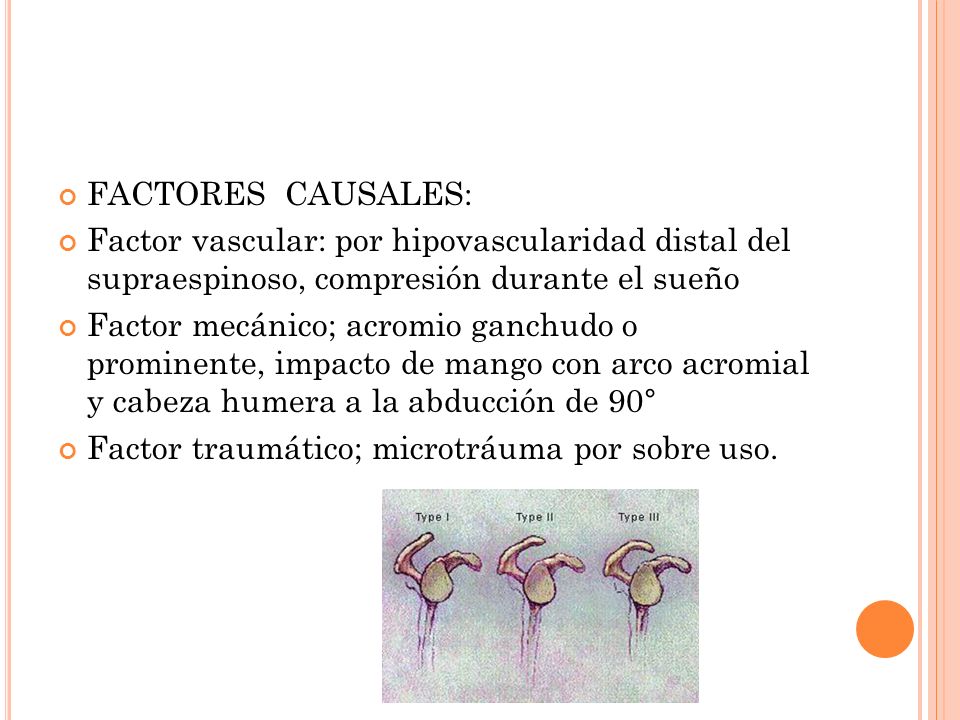 FACTORES CAUSALES: Factor vascular: por hipovascularidad distal del supraespinoso, compresión durante el sueño.