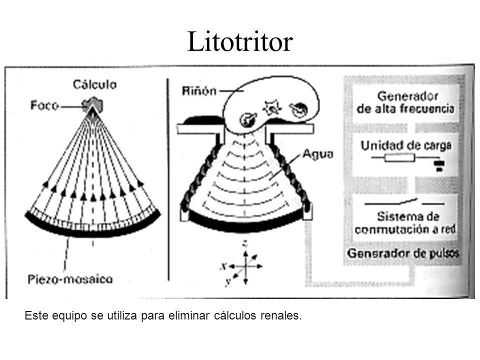 Litotritor Este equipo se utiliza para eliminar cálculos renales.