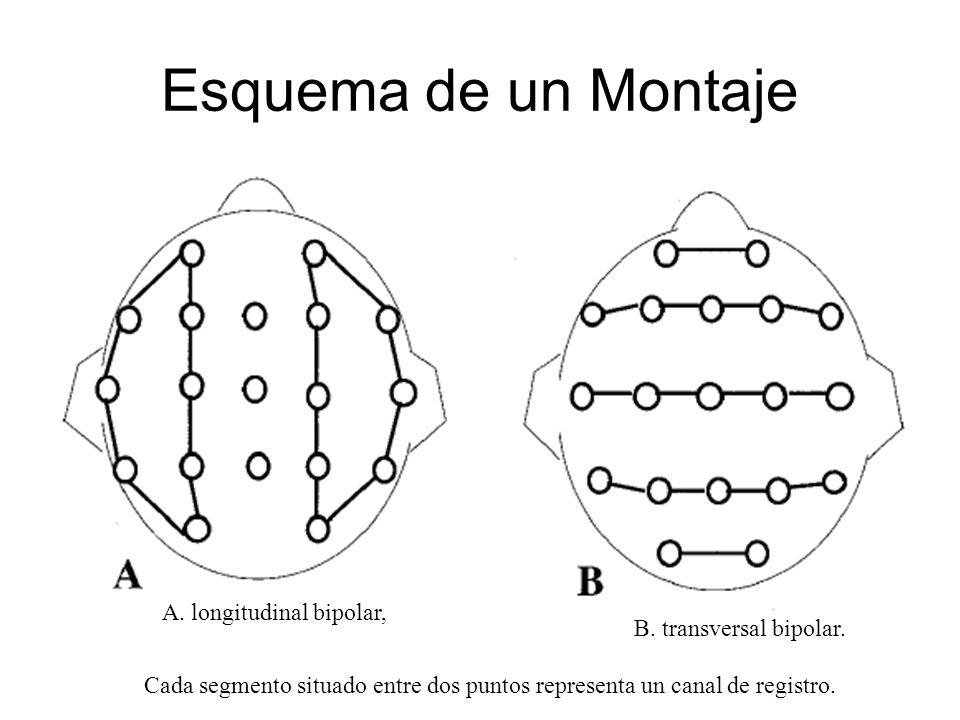 Esquema de un Montaje A. longitudinal bipolar, B. transversal bipolar.