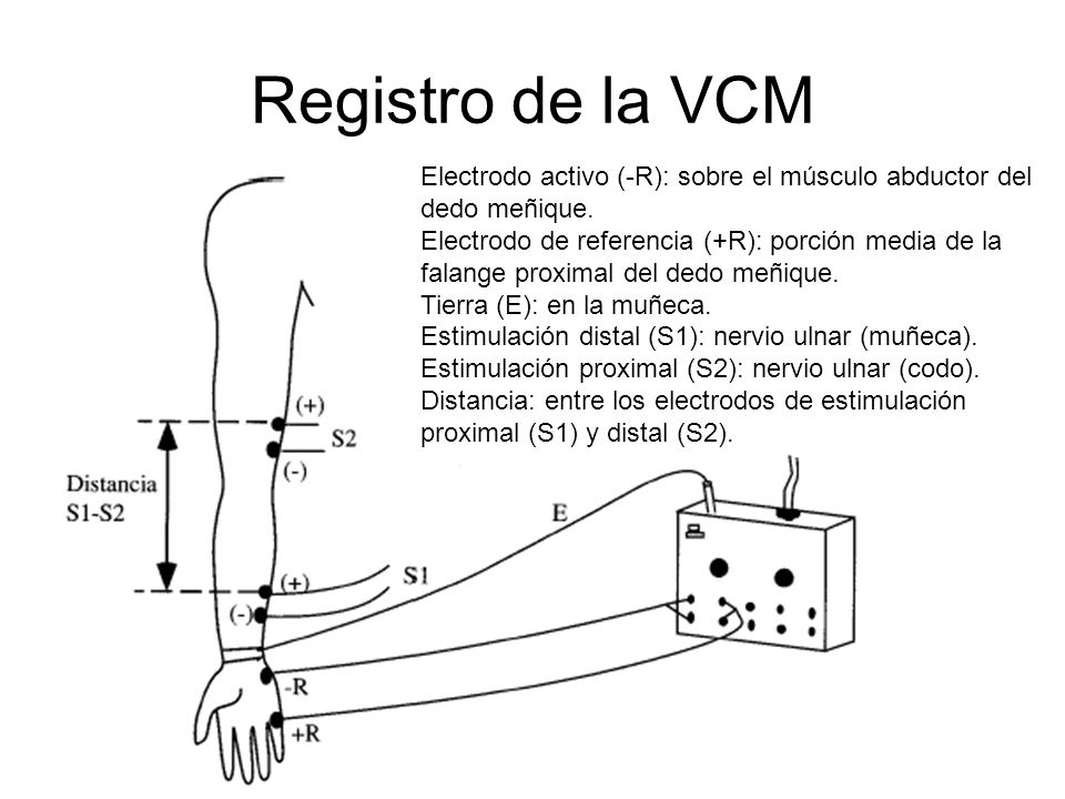 Registro de la VCM Electrodo activo (-R): sobre el músculo abductor del dedo meñique.