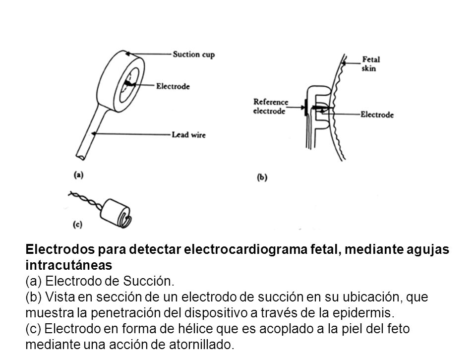 Electrodos para detectar electrocardiograma fetal, mediante agujas intracutáneas (a) Electrodo de Succión.