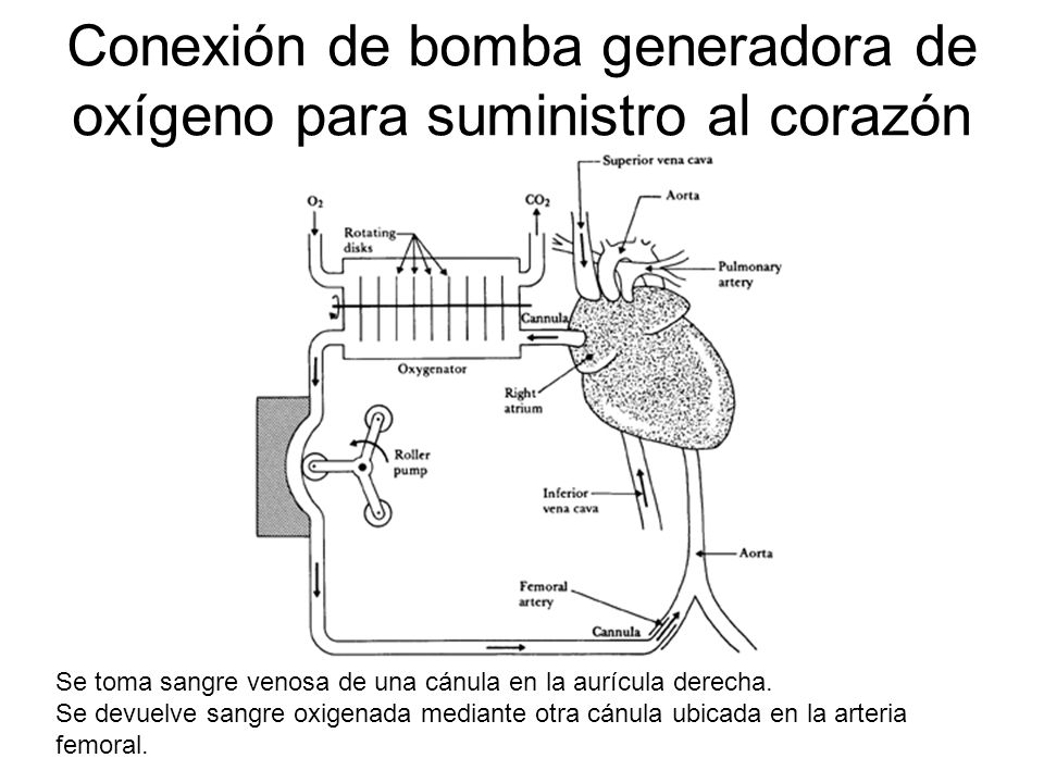Conexión de bomba generadora de oxígeno para suministro al corazón