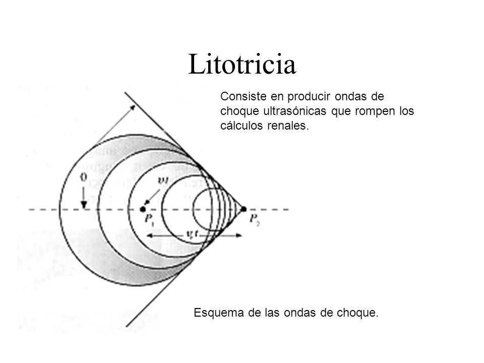 Litotricia Consiste en producir ondas de choque ultrasónicas que rompen los cálculos renales.