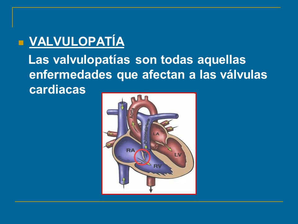 VALVULOPATÍA Las valvulopatías son todas aquellas enfermedades que afectan a las válvulas cardiacas