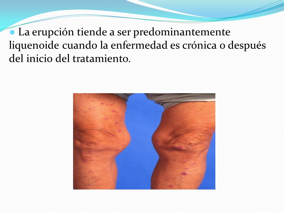● La erupción tiende a ser predominantemente liquenoide cuando la enfermedad es crónica o después del inicio del tratamiento.