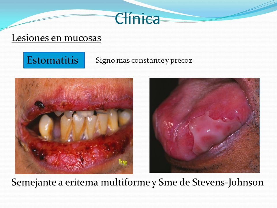 Clínica Lesiones en mucosas Semejante a eritema multiforme y Sme de Stevens-Johnson Estomatitis. Signo mas constante y precoz.