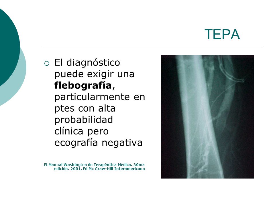 TEPA El diagnóstico puede exigir una flebografía, particularmente en ptes con alta probabilidad clínica pero ecografía negativa.