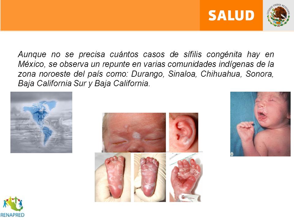 Aunque no se precisa cuántos casos de sífilis congénita hay en México, se observa un repunte en varias comunidades indígenas de la zona noroeste del país como: Durango, Sinaloa, Chihuahua, Sonora, Baja California Sur y Baja California.
