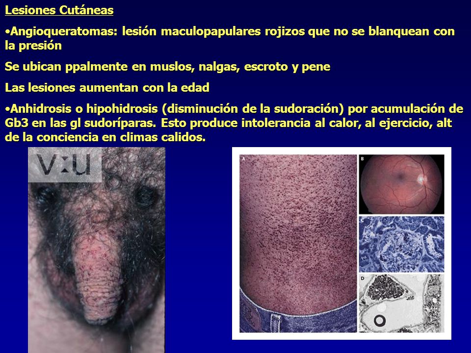 Lesiones Cutáneas Angioqueratomas: lesión maculopapulares rojizos que no se blanquean con la presión.