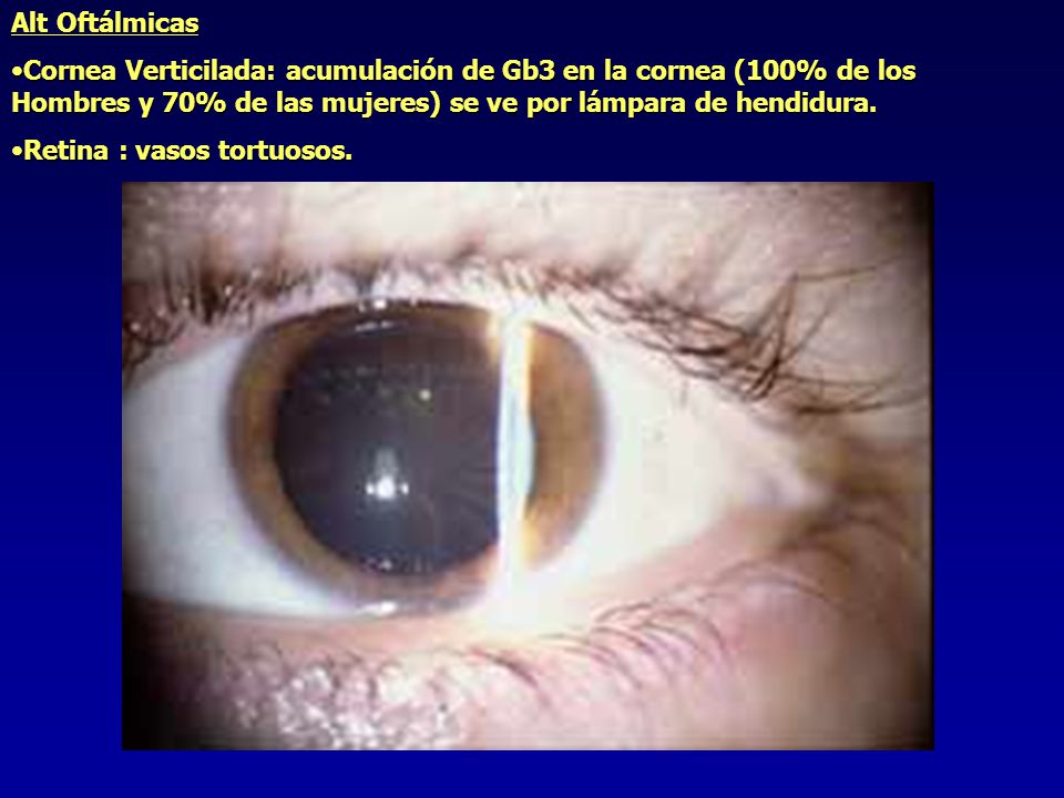 Alt Oftálmicas Cornea Verticilada: acumulación de Gb3 en la cornea (100% de los Hombres y 70% de las mujeres) se ve por lámpara de hendidura.