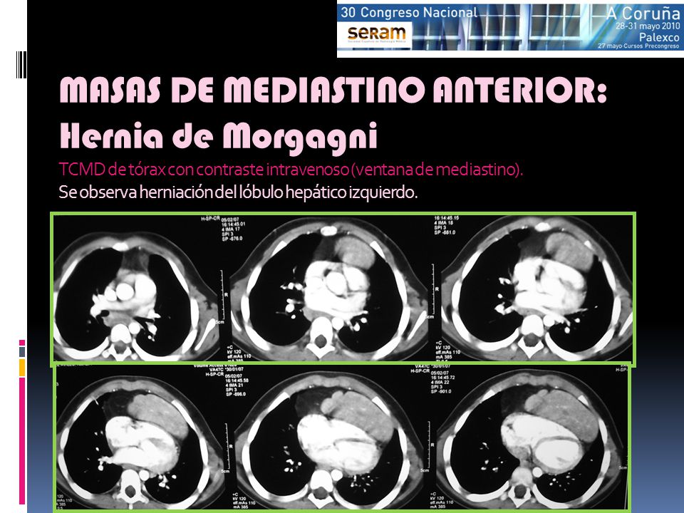MASAS DE MEDIASTINO ANTERIOR: Hernia de Morgagni TCMD de tórax con contraste intravenoso (ventana de mediastino).