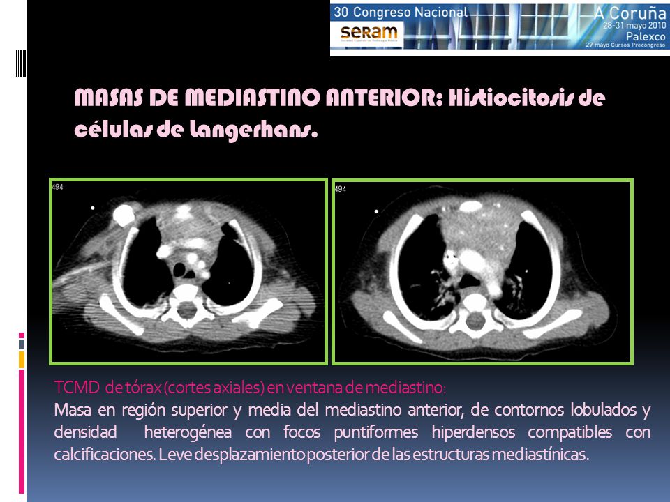 MASAS DE MEDIASTINO ANTERIOR: Histiocitosis de células de Langerhans.
