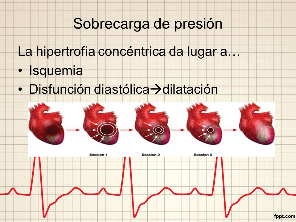 Sobrecarga de presión La hipertrofia concéntrica da lugar a… Isquemia
