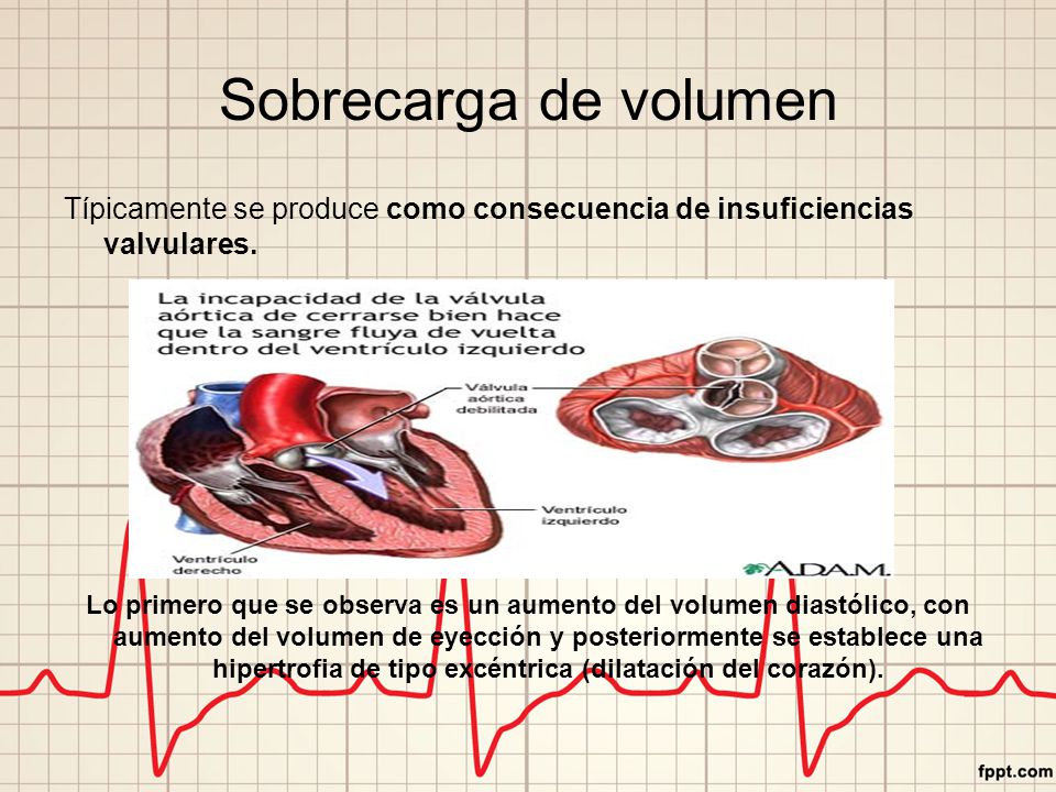 Sobrecarga de volumen Típicamente se produce como consecuencia de insuficiencias valvulares.