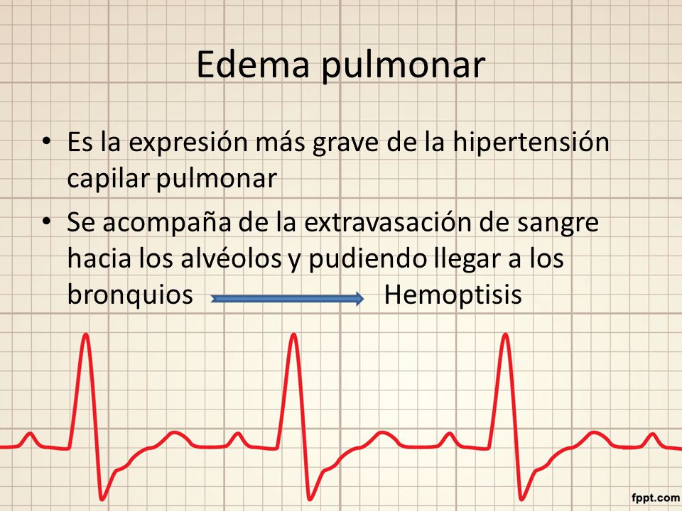 Edema pulmonar Es la expresión más grave de la hipertensión capilar pulmonar.