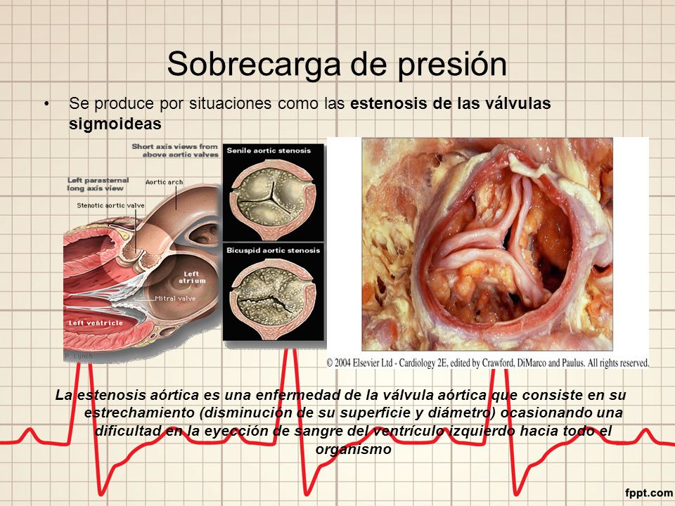 Sobrecarga de presión Se produce por situaciones como las estenosis de las válvulas sigmoideas.
