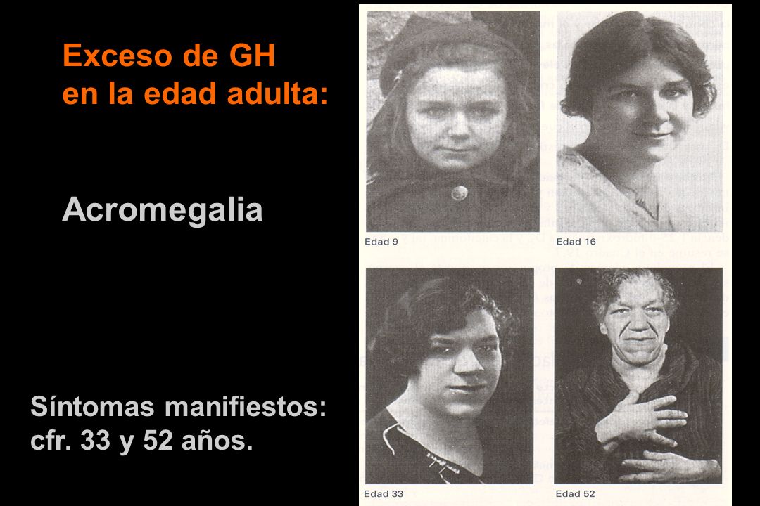 Acromegalia Exceso de GH en la edad adulta: Síntomas manifiestos: