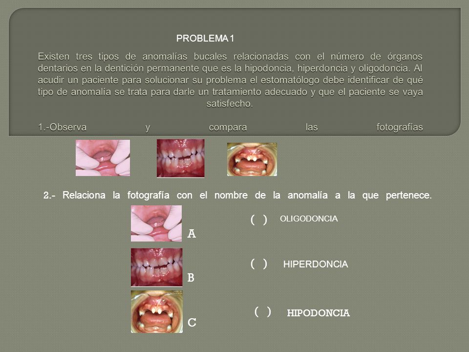 Existen tres tipos de anomalías bucales relacionadas con el número de órganos dentarios en la dentición permanente que es la hipodoncia, hiperdoncia y oligodoncia. Al acudir un paciente para solucionar su problema el estomatólogo debe identificar de qué tipo de anomalía se trata para darle un tratamiento adecuado y que el paciente se vaya satisfecho. 1.-Observa y compara las fotografías